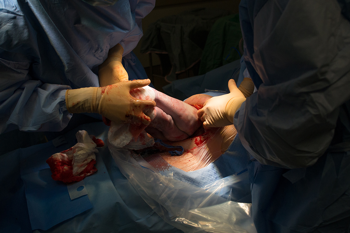 Elliana Gilbert cesarean breech 9.jpg