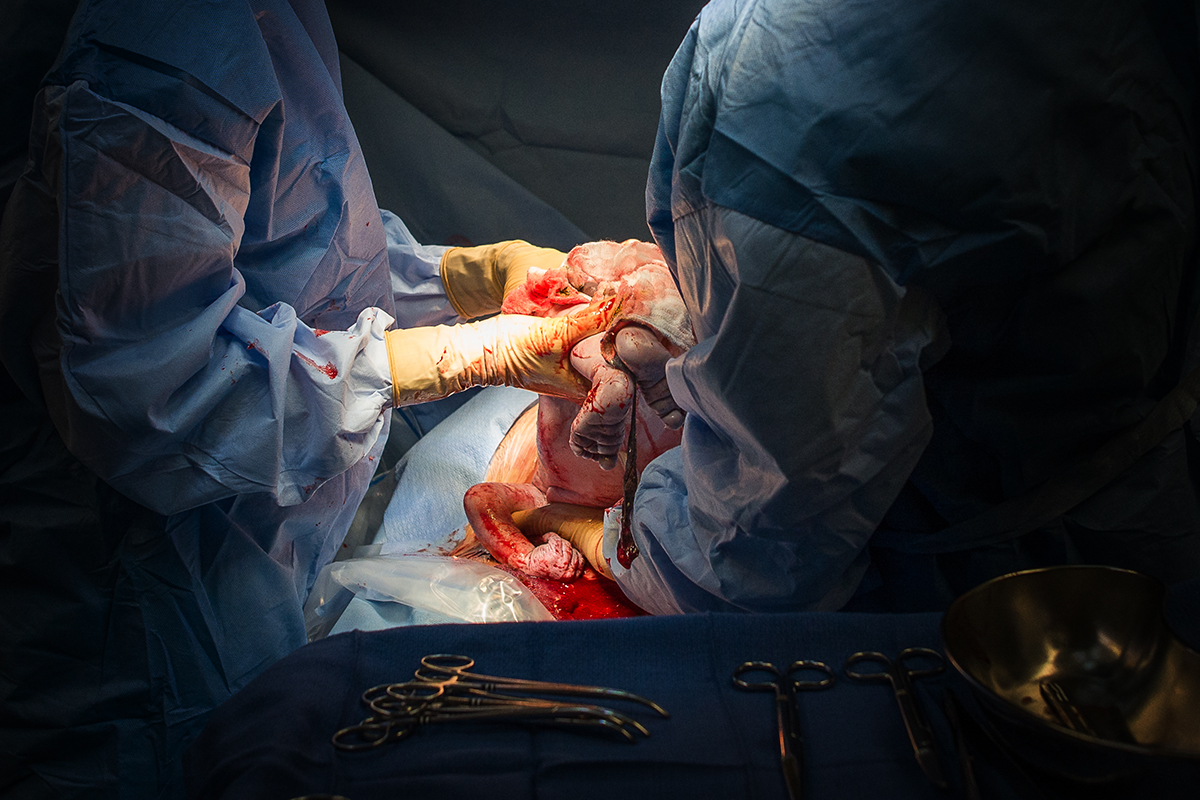 Elliana Gilbert cesarean breech 10.jpg
