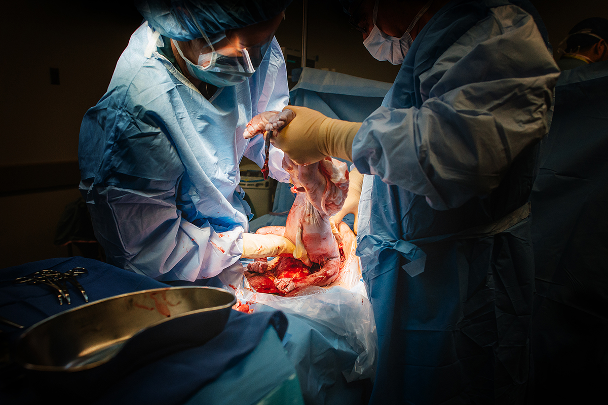 Elliana Gilbert cesarean breech 11.jpg