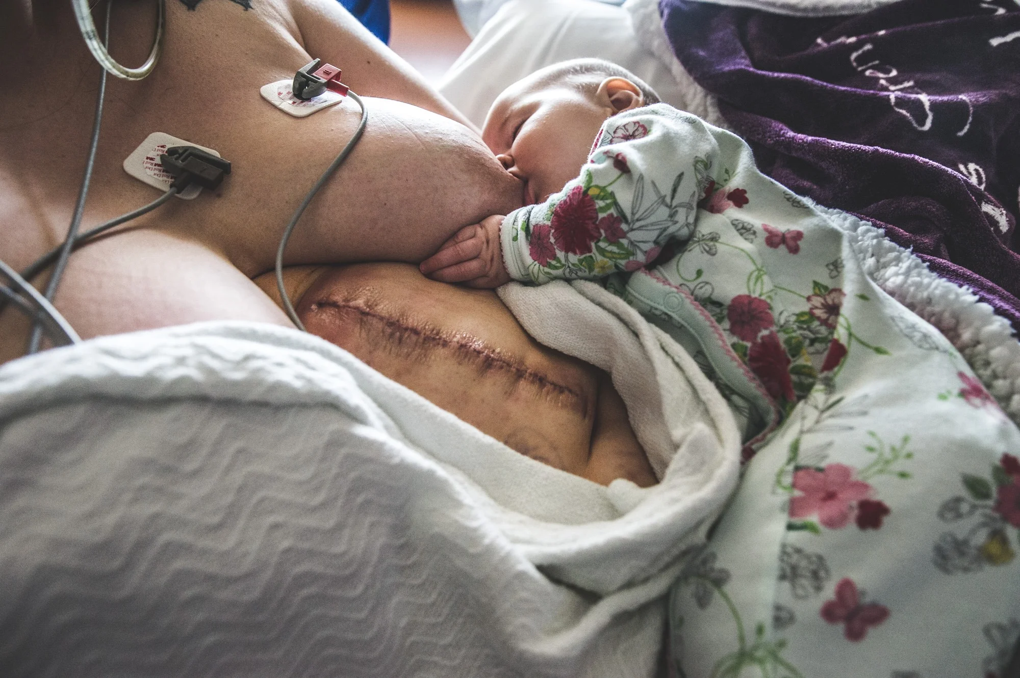 Samantha Hines Documentary Family Photography / https://www.samanthahinesphotography.com/ Her nursing relationship was sacred, but her life saving surgery was vital. The fear that this surgery would end her ability to nurse her four month old daughter was terrifying to her. And yet, this sweet baby didn't skip a beat, and I imagine, their relationship is that much stronger because of it. 