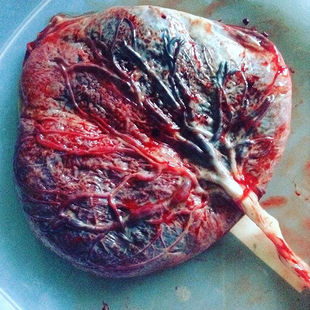 Gorgeous life giving placenta! 
#placenta #takebackpostpartum #pregnancy #birth