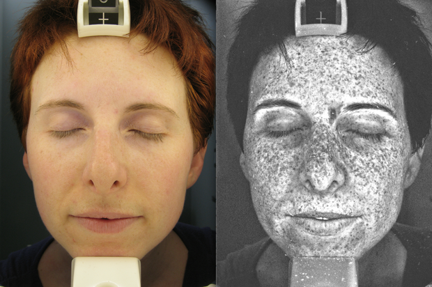 UV Facial Lamp shows sun damage under the skin we can't normally see.