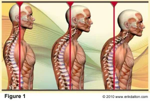 Curvature of the spine seen in "normal" aging and over sitting. This is preventable. With bodywork and movement homeworkit can generally be corrected.