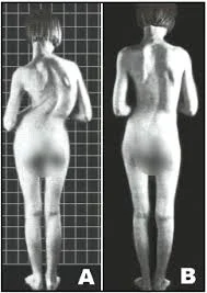 Left A: Untreated extreme scoliosis curvature. Right B: Treated. Although the scoliosis may not be gone, it's a heck of a lot easier to live with!