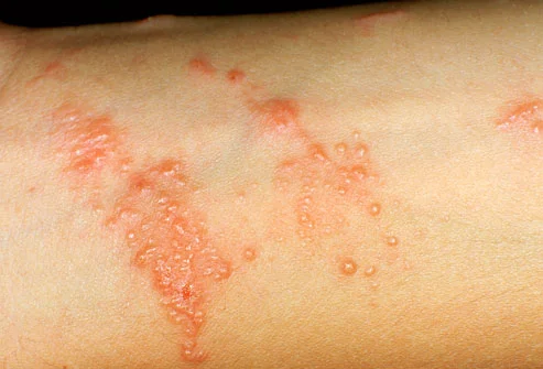 Rash from poison ivy.