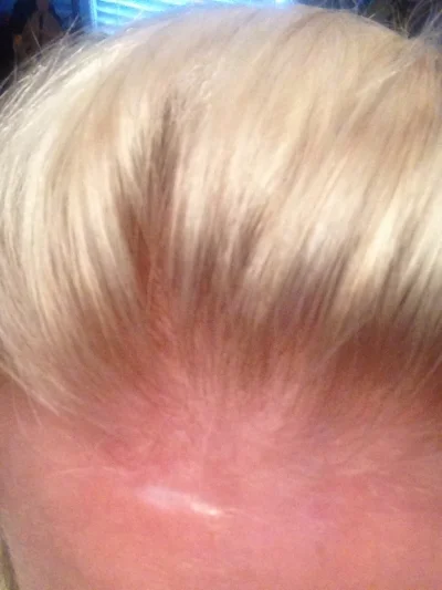This is today!!! Scar quite visible! 