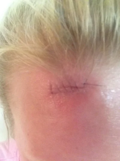This is what incision looked like after procedure to remove! I wish I had a previous picture of the lesion to show just how little the lesion was!!! It was less than a pencil eraser in size!!!! 