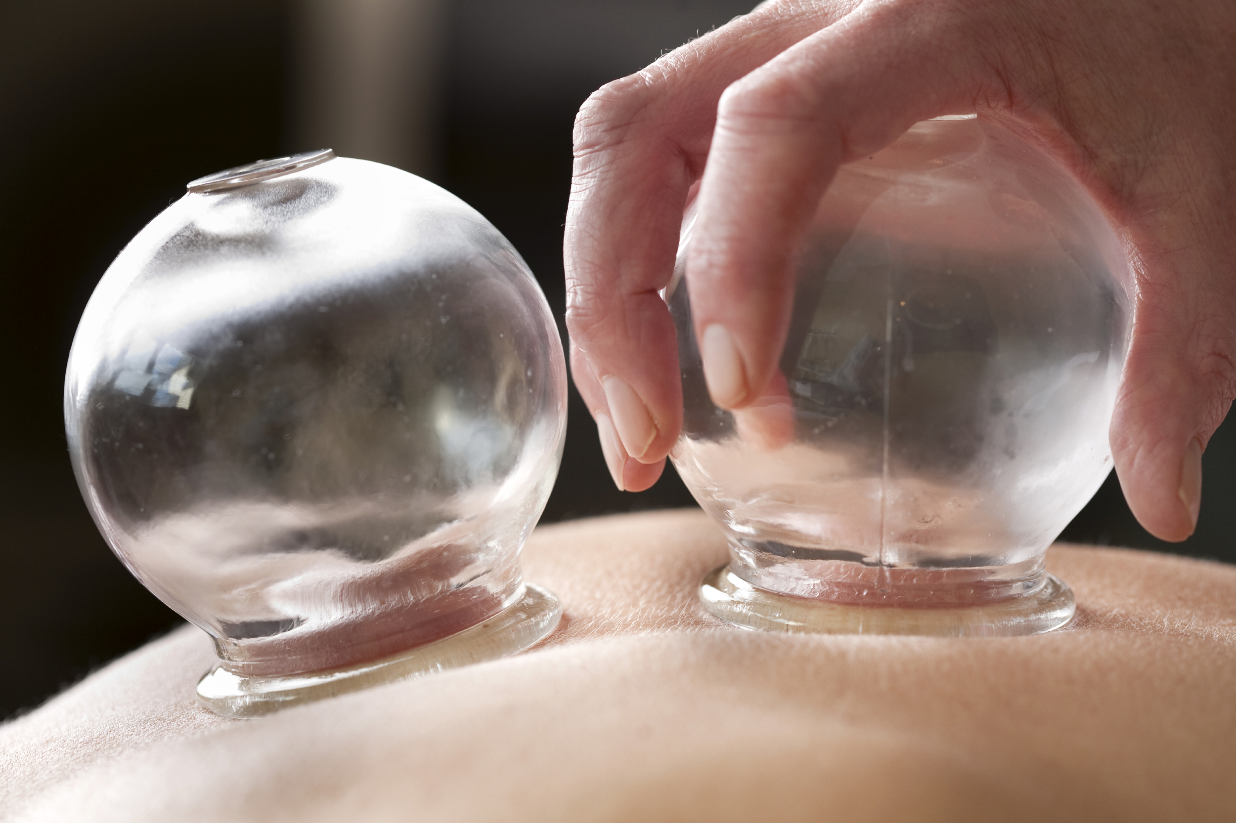 <b>CUPPING</b> THERAPY