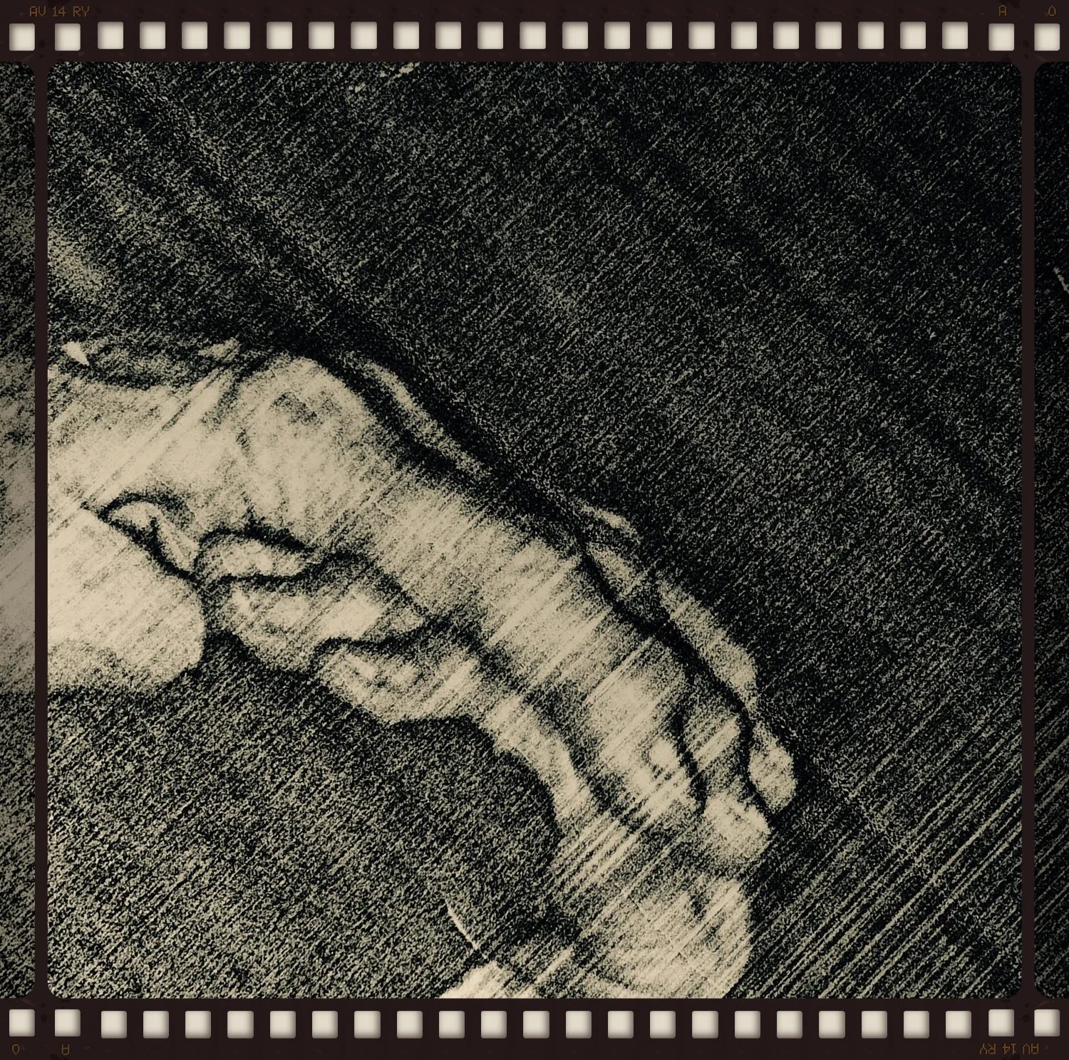 Psoriatic Arthritis