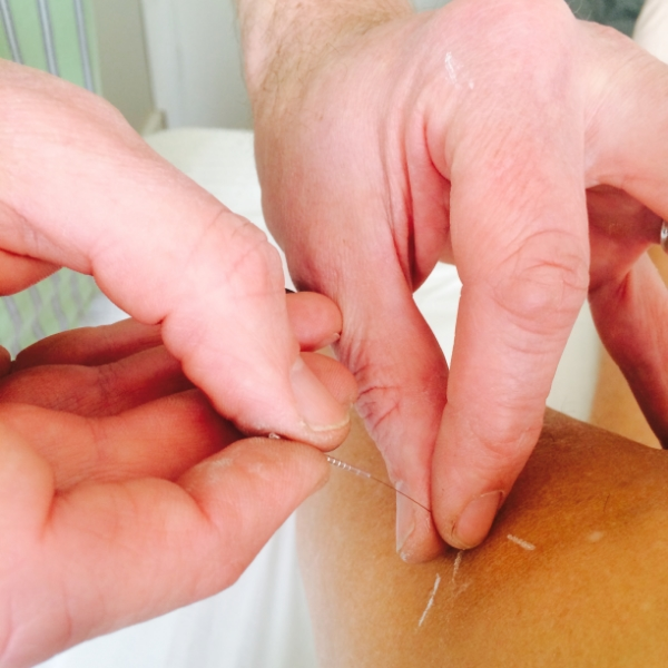 Acupuncture