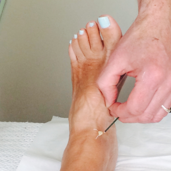 Sometimes the practioner uses moxa, which they light to induce a little heat into the body to stimulate circulation. It doesn't hurt and feels really great on sore muscles.