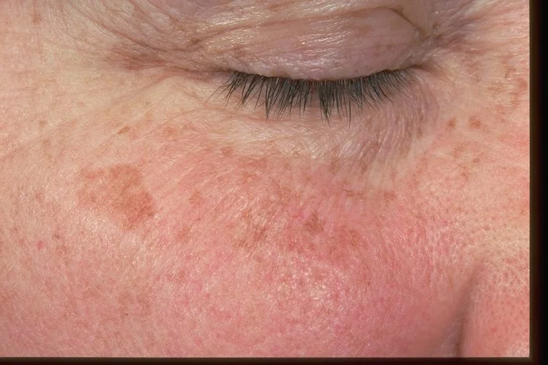 Laser Treat Liver Spots Solar Lentigo Phillips Aesthetic Dermatology