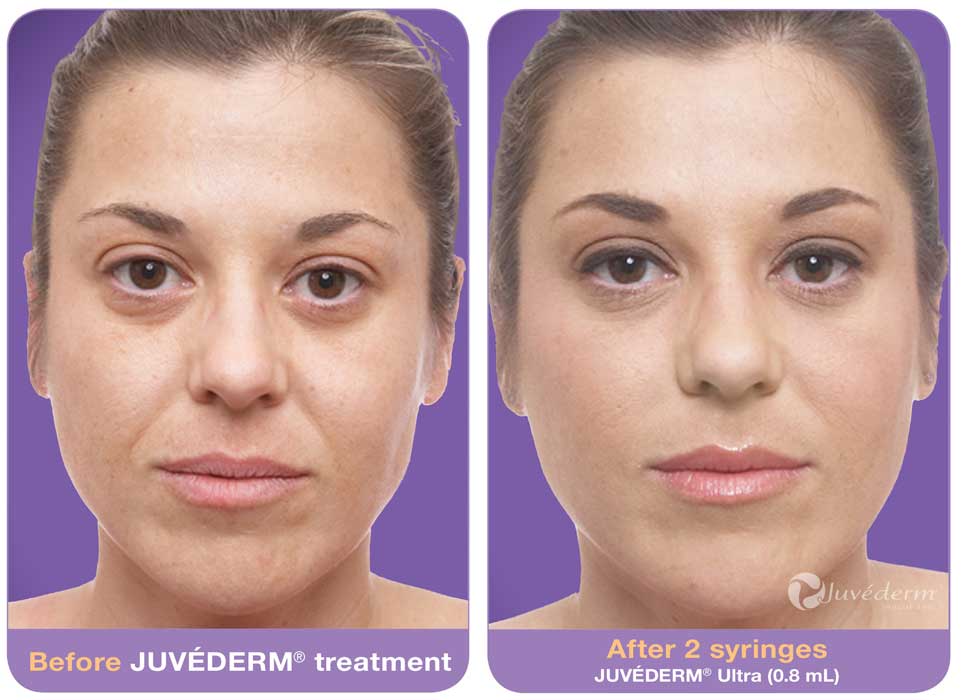 JuvedermJenniferBAFull.jpg