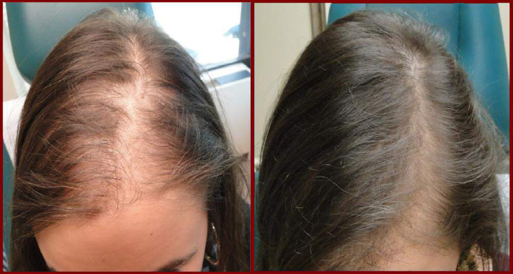 before-and-after-prp-hair-restoration-pams.jpg
