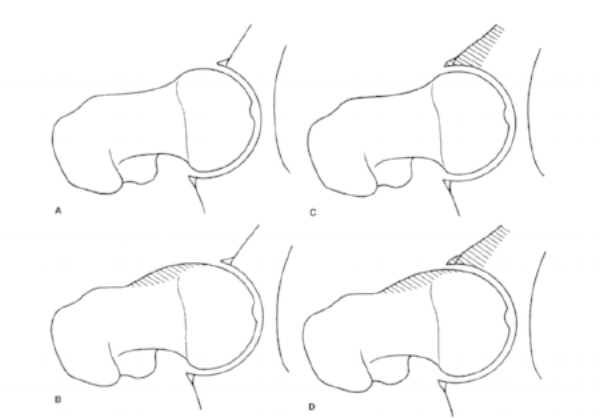 hip impingment physio.png
