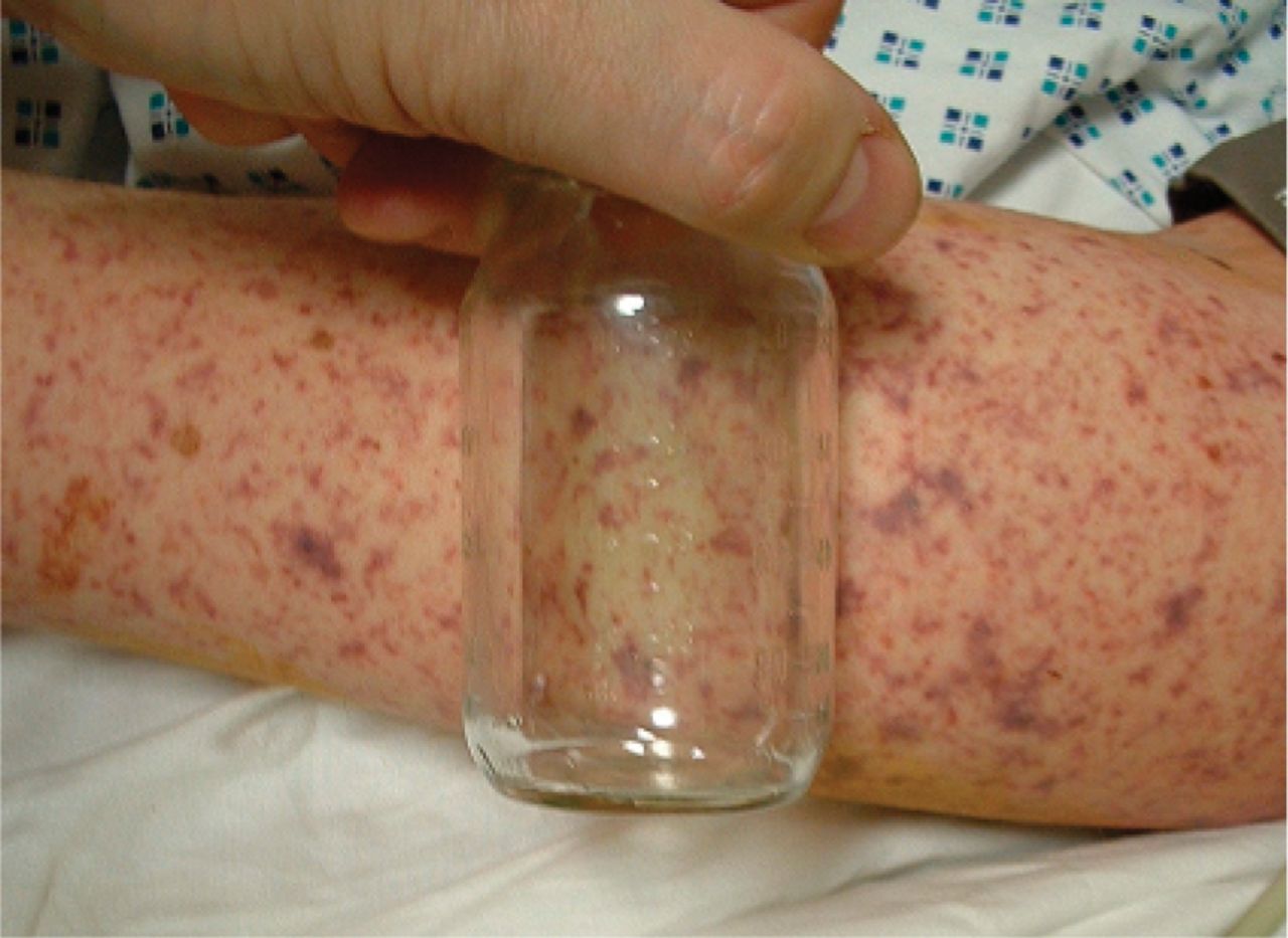 The non-blanching rash of bacterial meningitis does not change colour when pressed