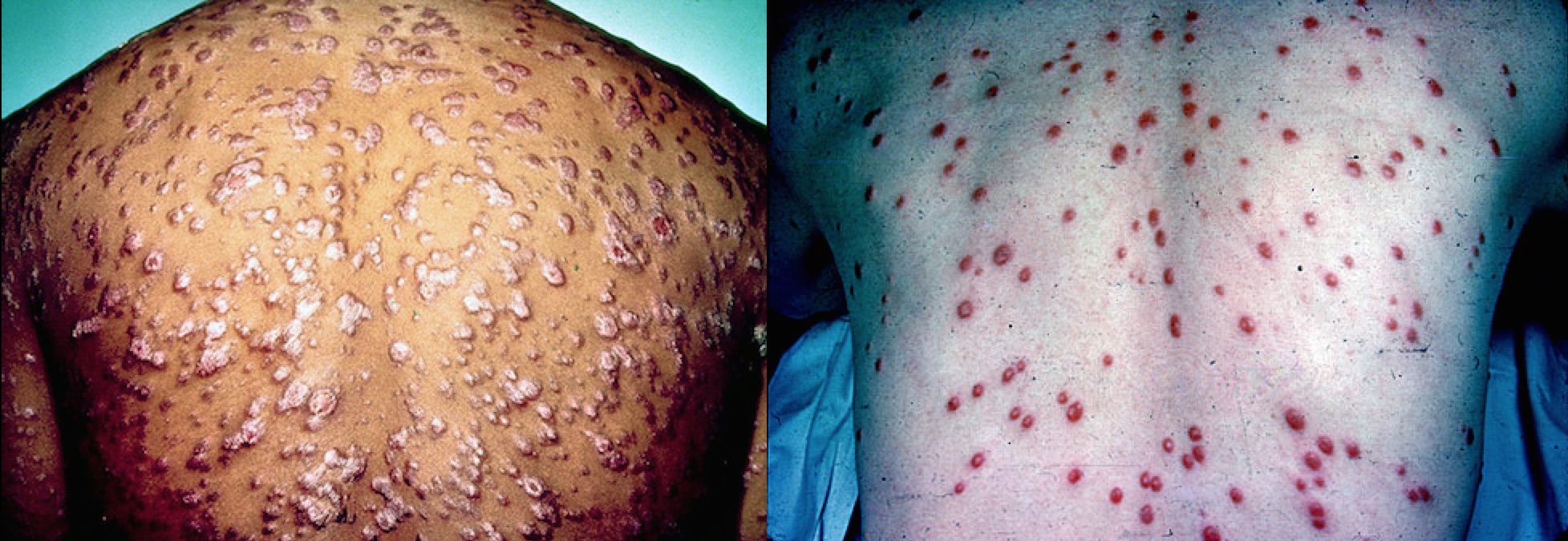 Two good examples of the rash of secondary syphilis. All those spots are teeming with infectious bacteria.