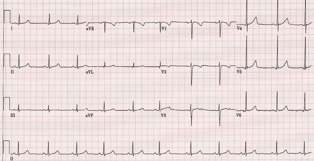What a real-life (and thankfully normal) ECG looks like