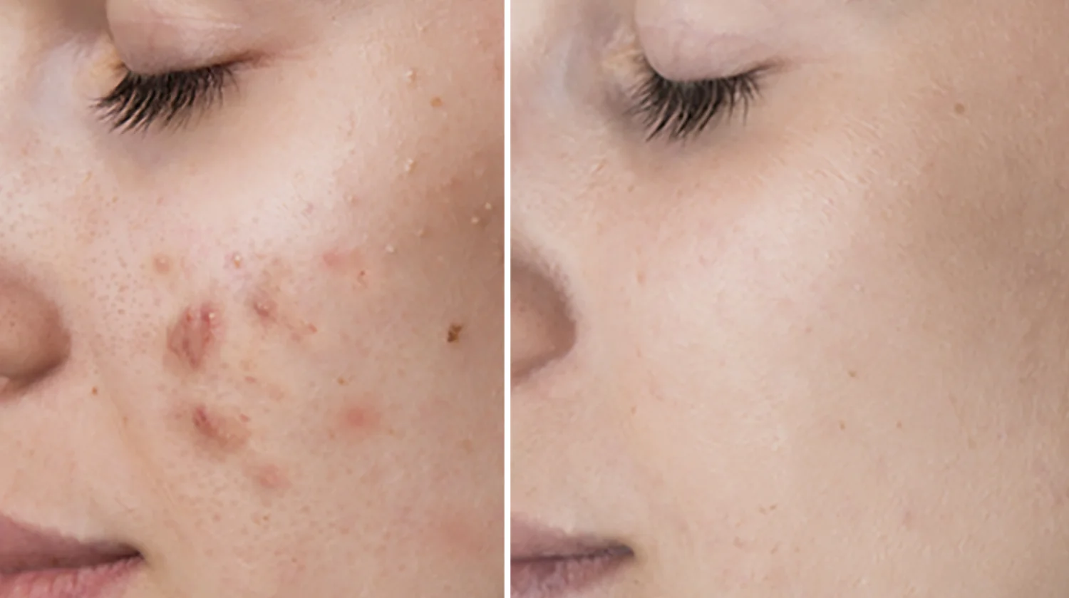 microneedling-acne-treatment-in-houston.jpg