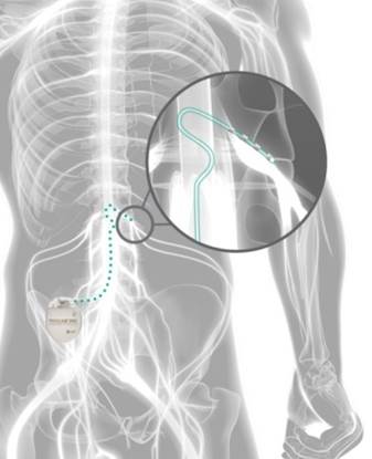 Spinal Cord Stimulation for Chronic Pain, Reduce Pain Medication