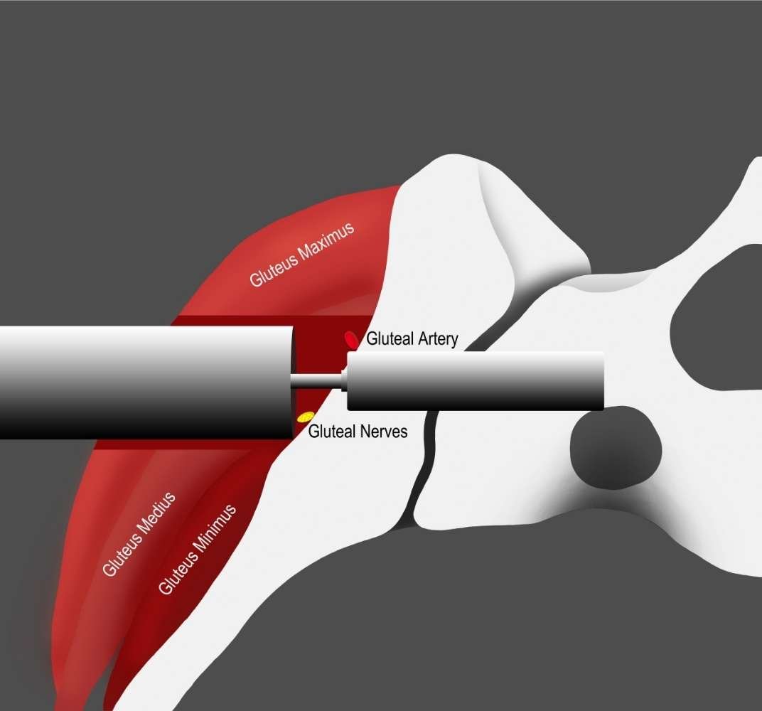 Transloc Device TransLoc 3D™ SI Joint Fusion System — Advanced Diagnostic Pain ...