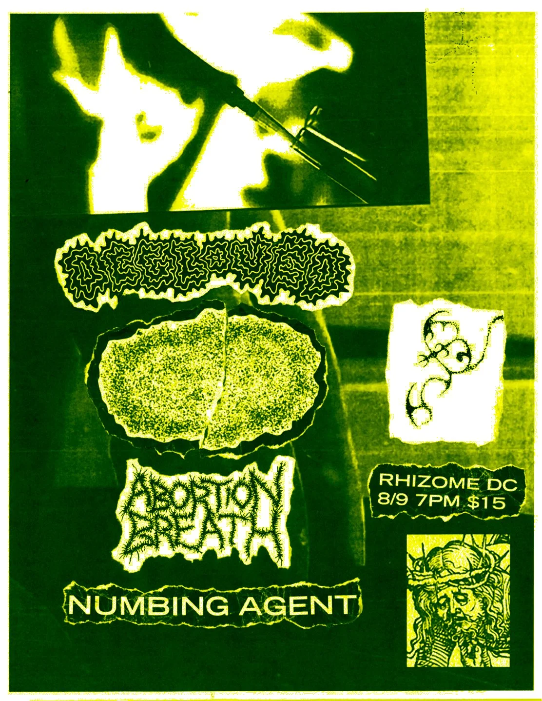 Degloved / Abortion Breath / Hydroencephalocystocele / Numbing Agent