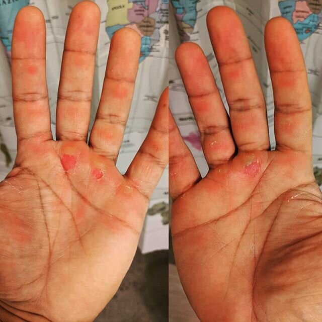 I may have overdone it climbing today. I now realize that palms are very important parts of your hands. #ouch #tyingtoohard #itstapeandgauze4me