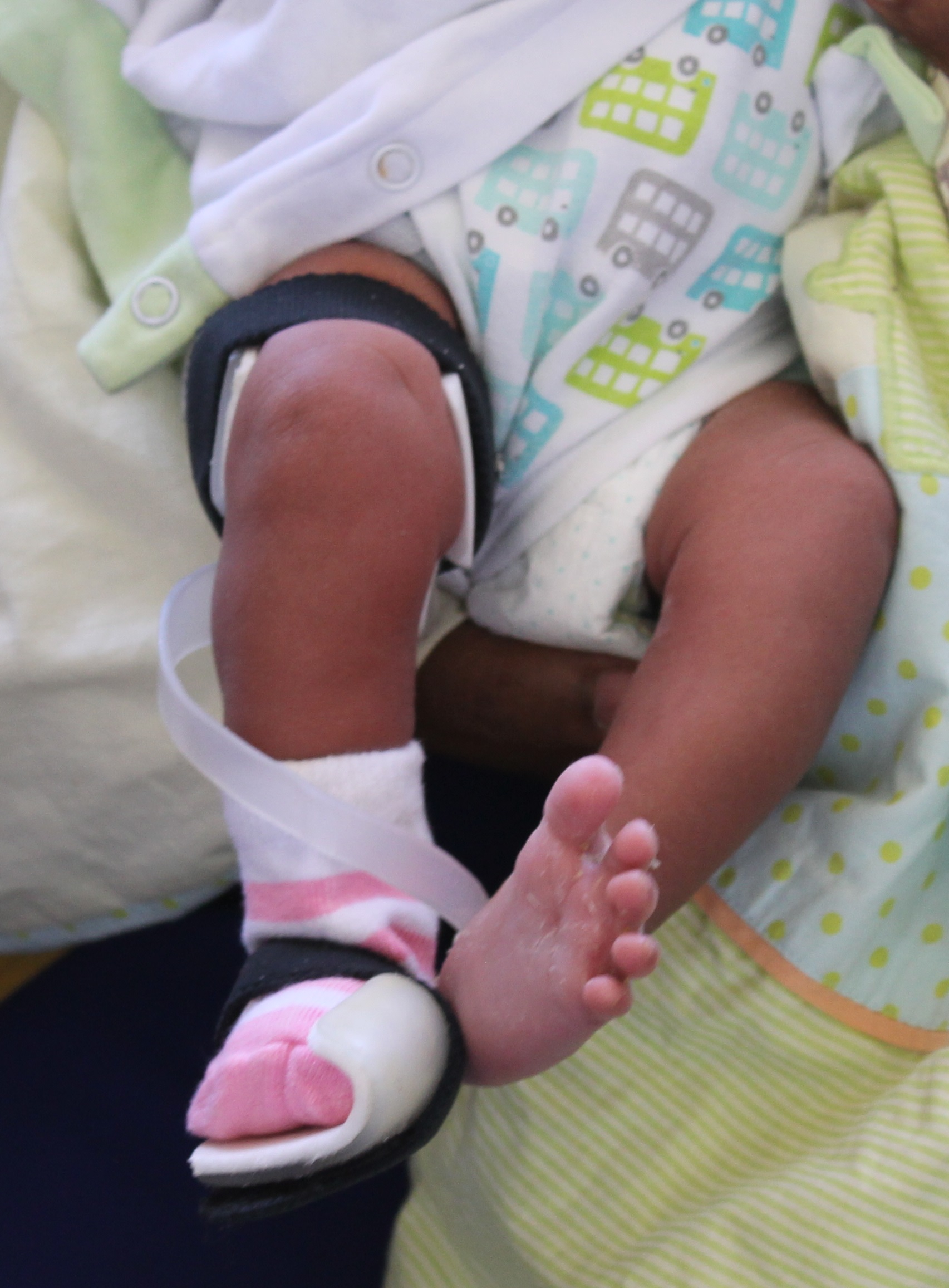 Baby born with club foot 300253-What happens when a baby is born with a club foo