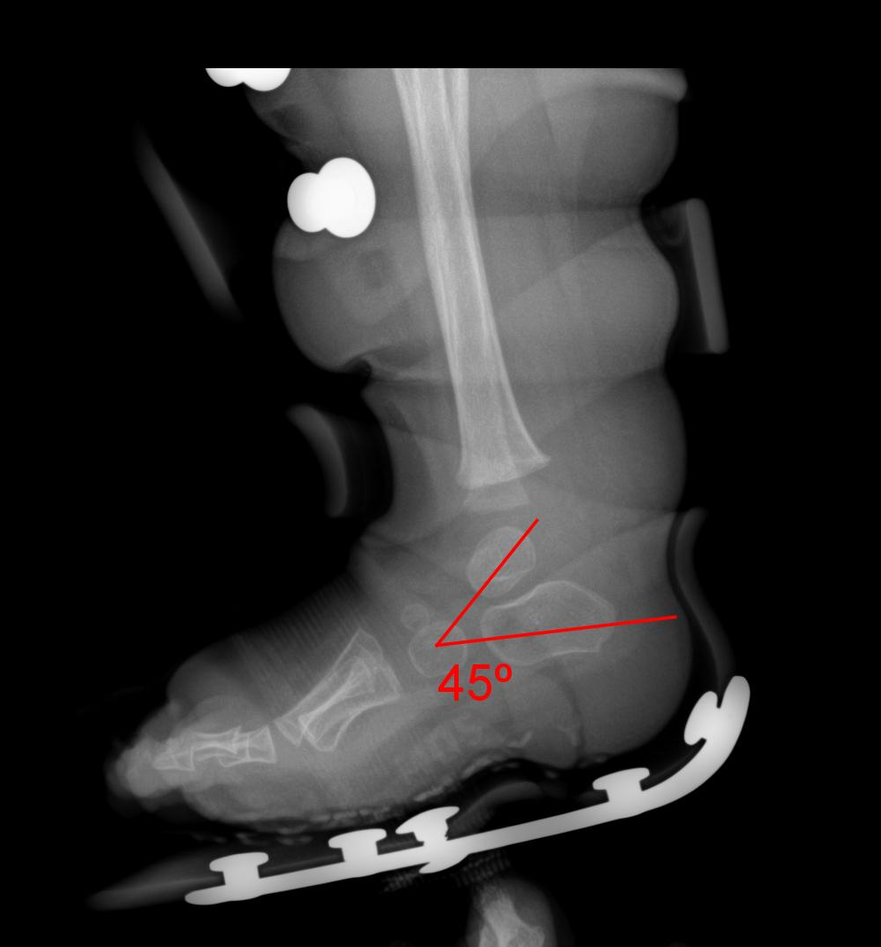 In brace X-ray showing calcaneal dorsiflexion.png