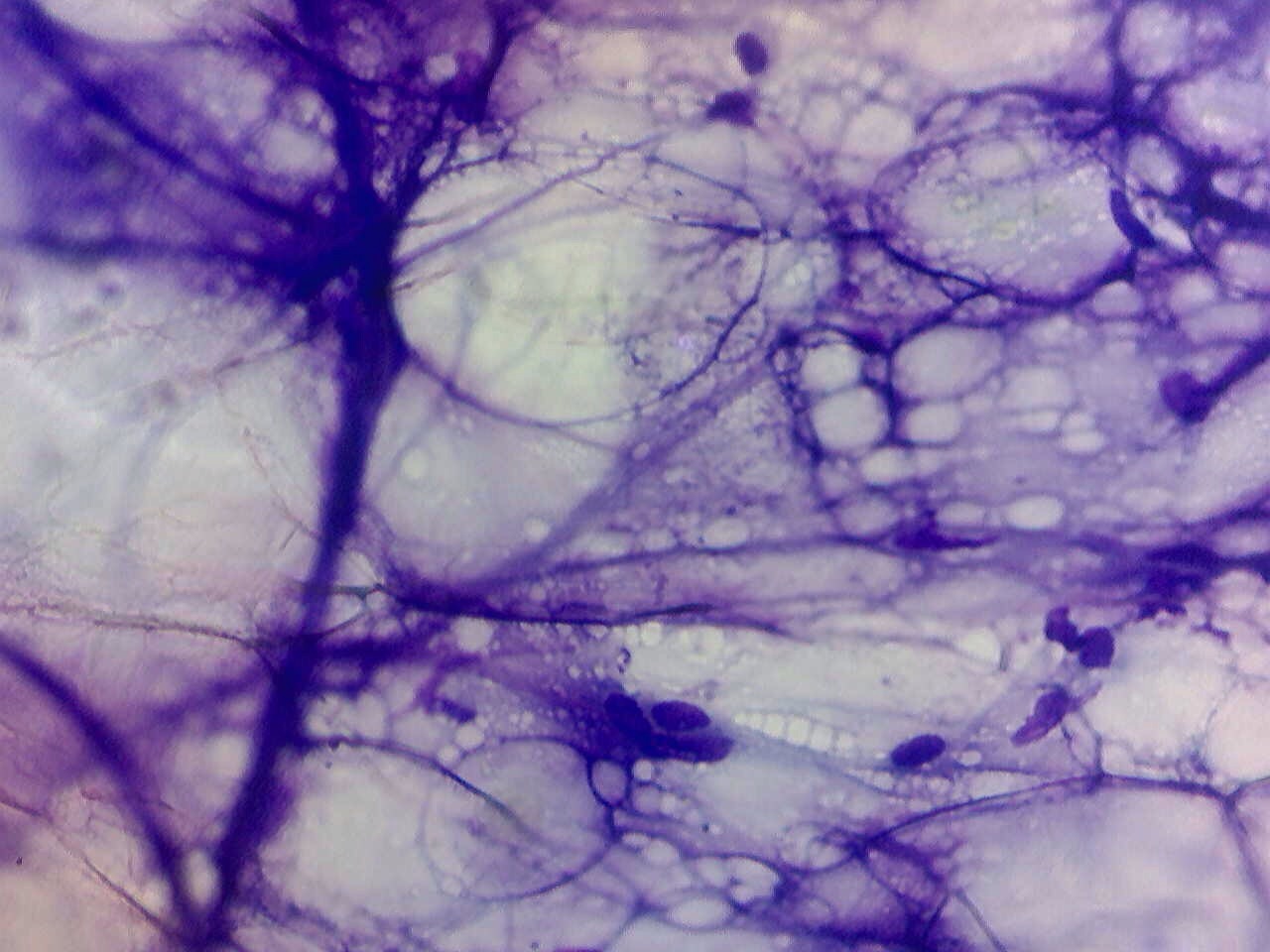 Sample taken from a lipoma, a benign fat tumor 