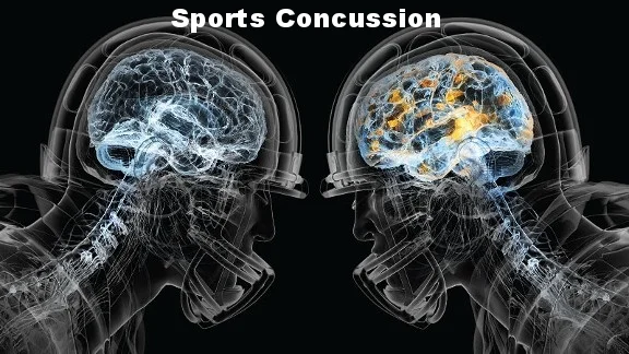 Concussion Physiotherapy.jpg