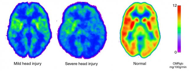 This image depicts the "metabolic crisis" which occurs following a concussion. at precisely the time that The brain requires blood flow to heal, the brain is significantly starved of blood supply.