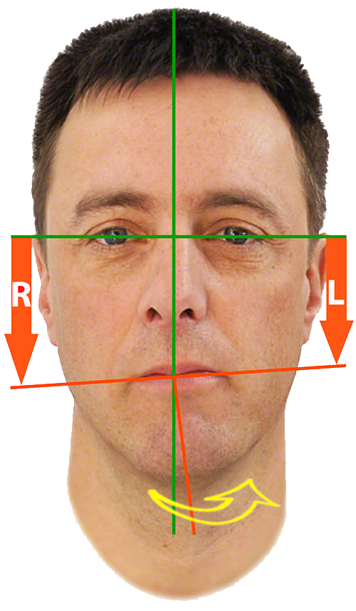 TMJ & Headaches Barrie — Resolution Physiotherapy & IMS Clinic