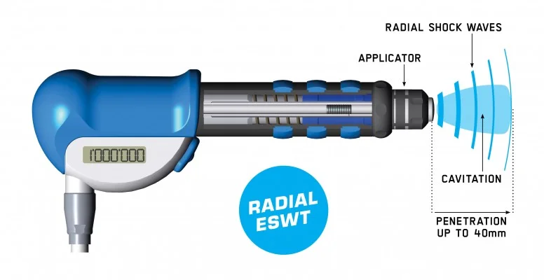 Shockwave Therapy Barrie.jpg