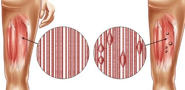shockwave therapy barrie.jpg