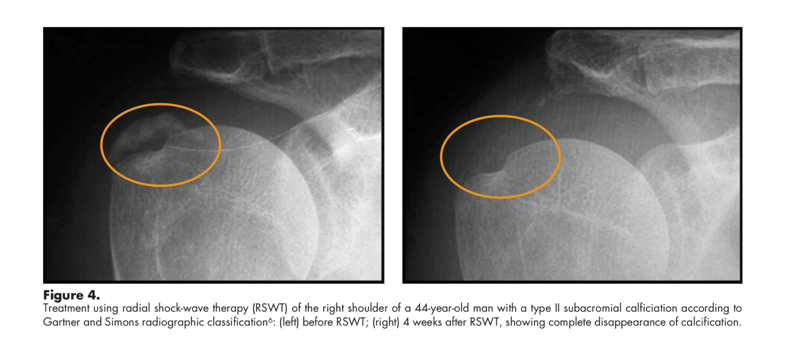 shoulder pain barrie.jpg
