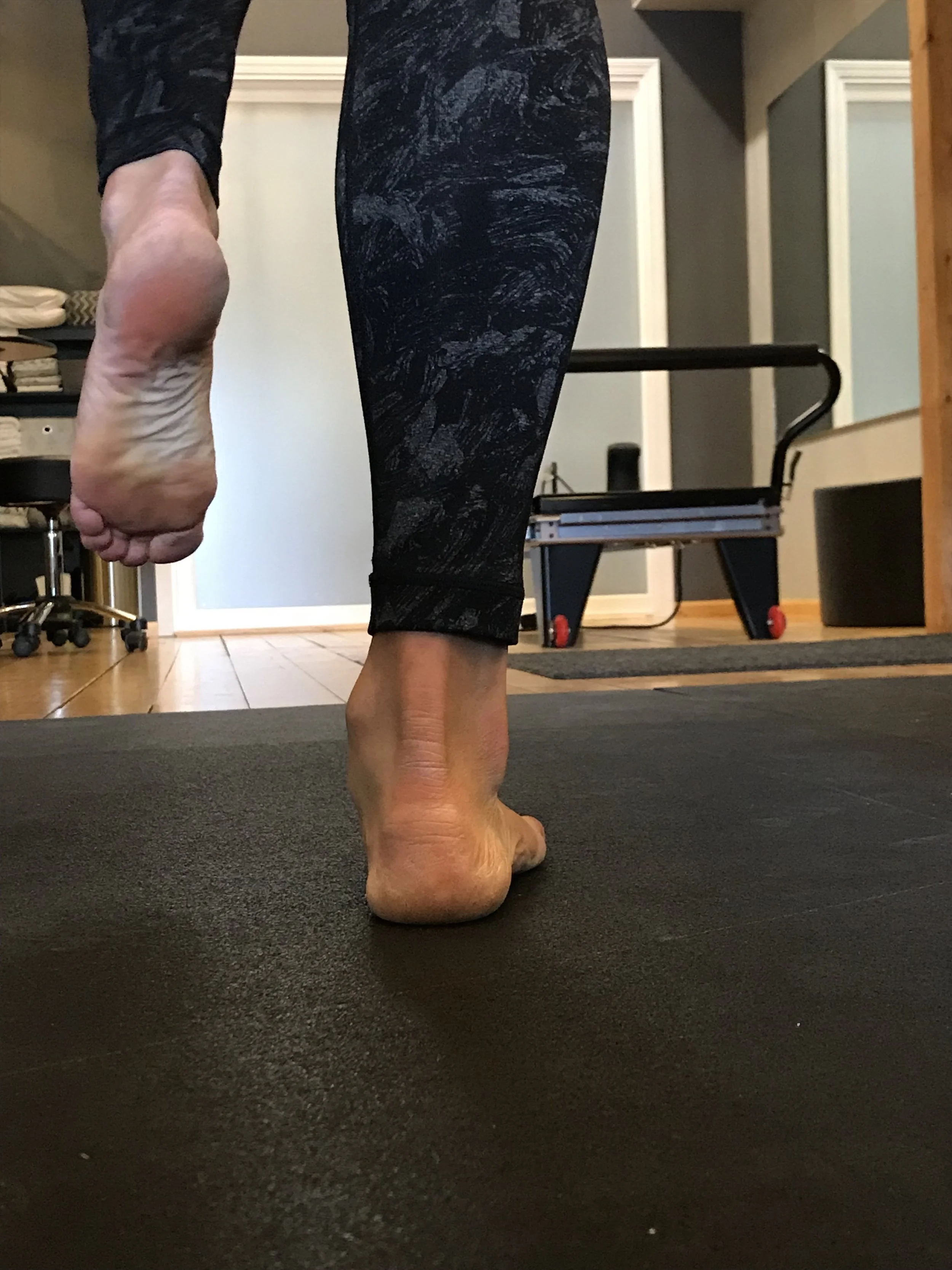 Collapse of the medial longitudinal arch places excess stress on the plantar fascia