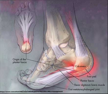 https://www.consultant360.com/content/plantar-fasciitis-office-management
