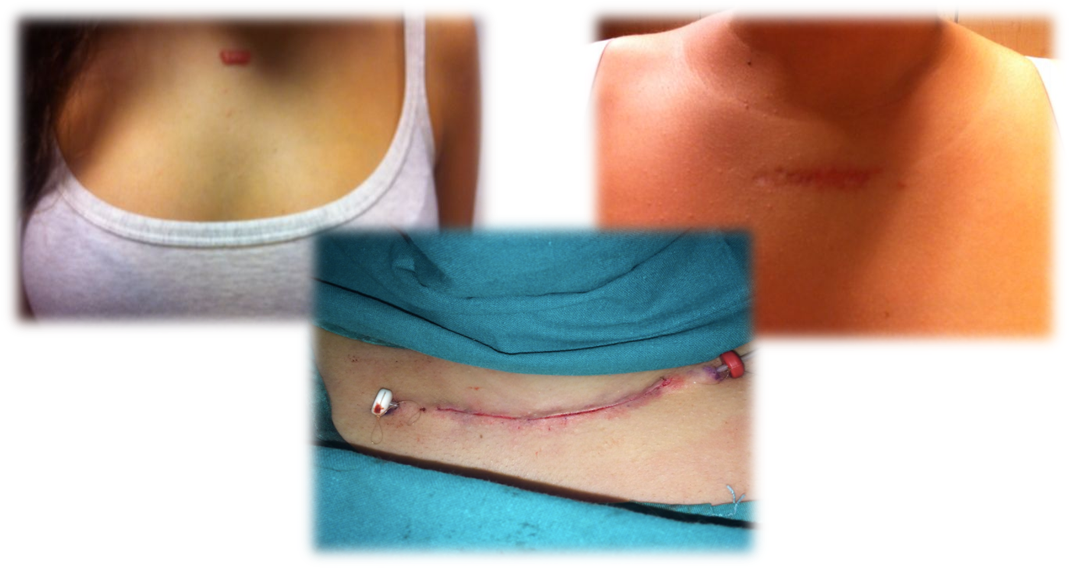  Tratamiento de una cicatriz queloide con braquiterapia postoperatoria
