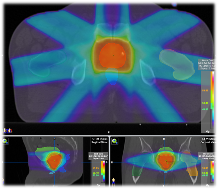 #ESMO19. Radioterapia postoperatorie ar putea fi evitată la pacienții cu cancer de prostată