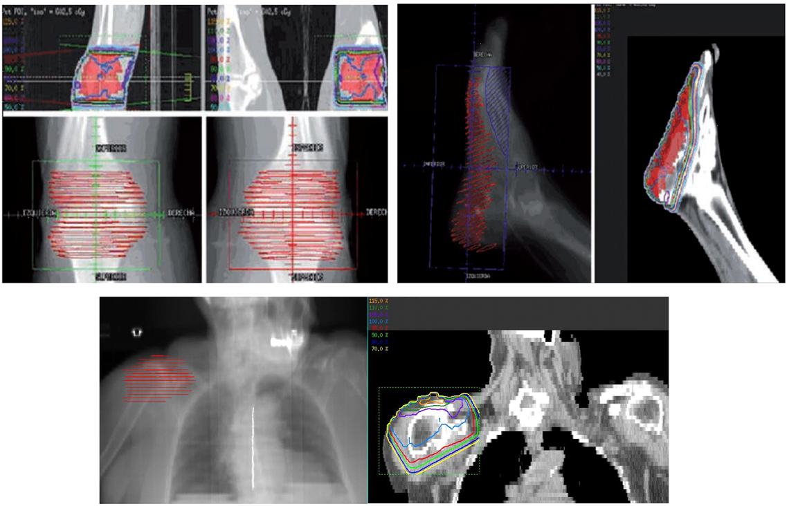 radioterapie articulară tsifran cu inflamația articulațiilor