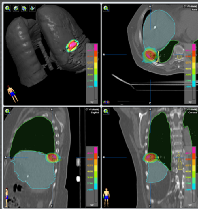 Mts pulmonar LID.png