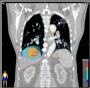 Fumatul şi oncologia - Rolul surorii medicale - ecancer Cancer prostata y huesos