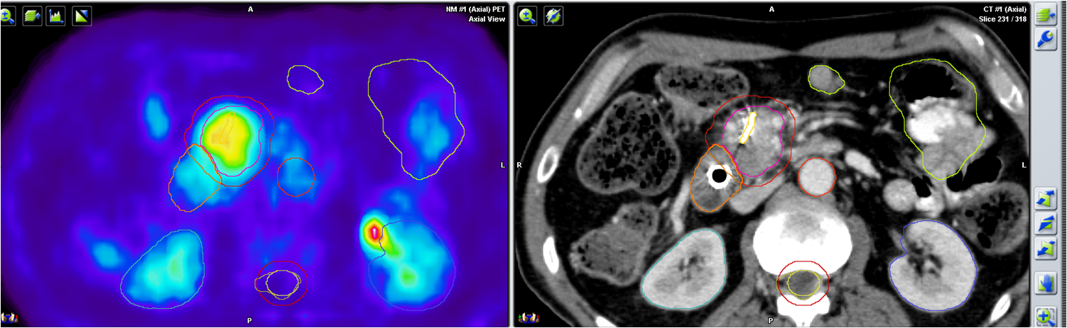 simulacion PET pancreas.png