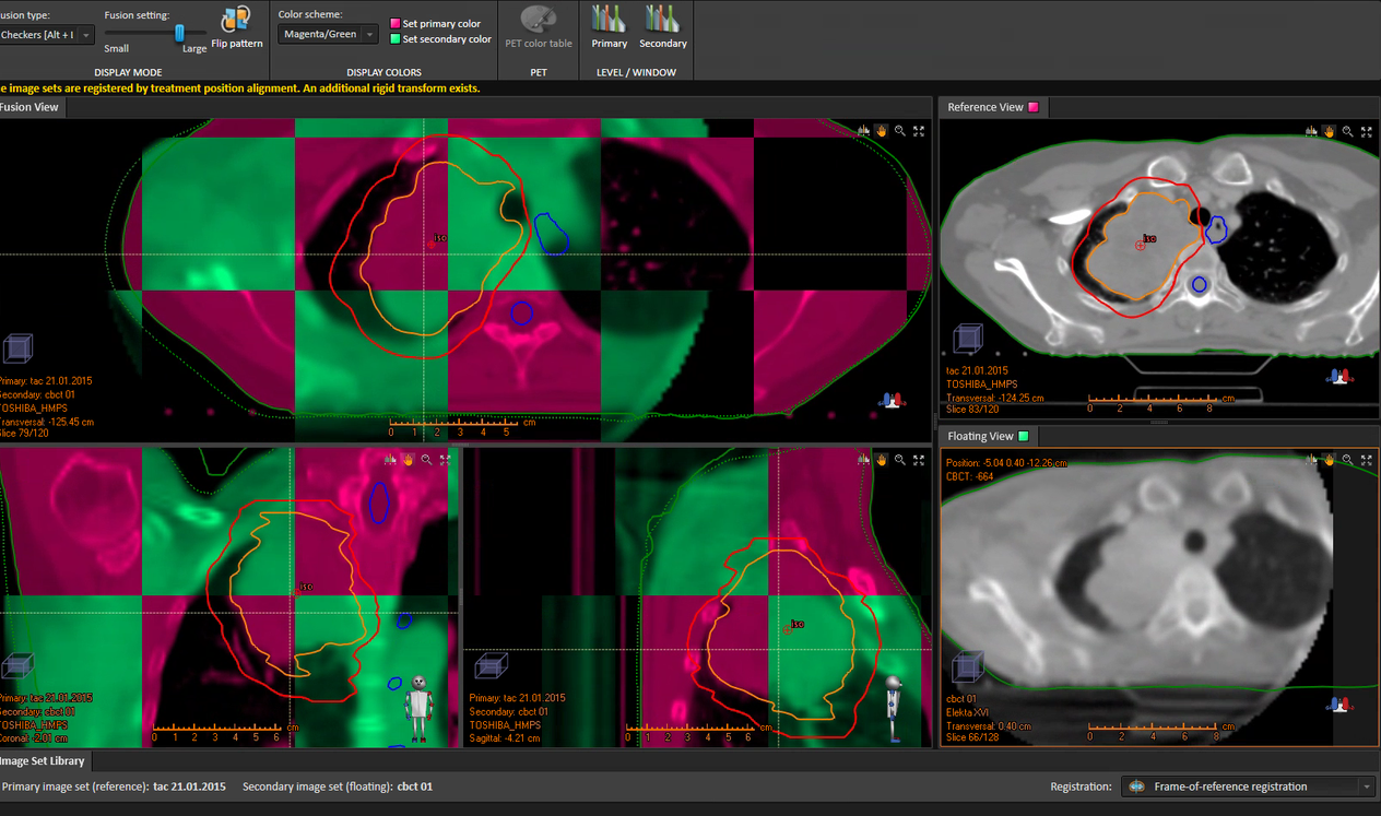 Imagen de simulación CT de referencia (magenta) frente a imagen on-line (verde) previa a tratamiento obtenida en acelerador VERSA HD mediante sistema de imagen kV-CBCT. Se observan variaciones anatómicas principalmente en regiones óseas de mayor movilidad y perímetro del paciente.