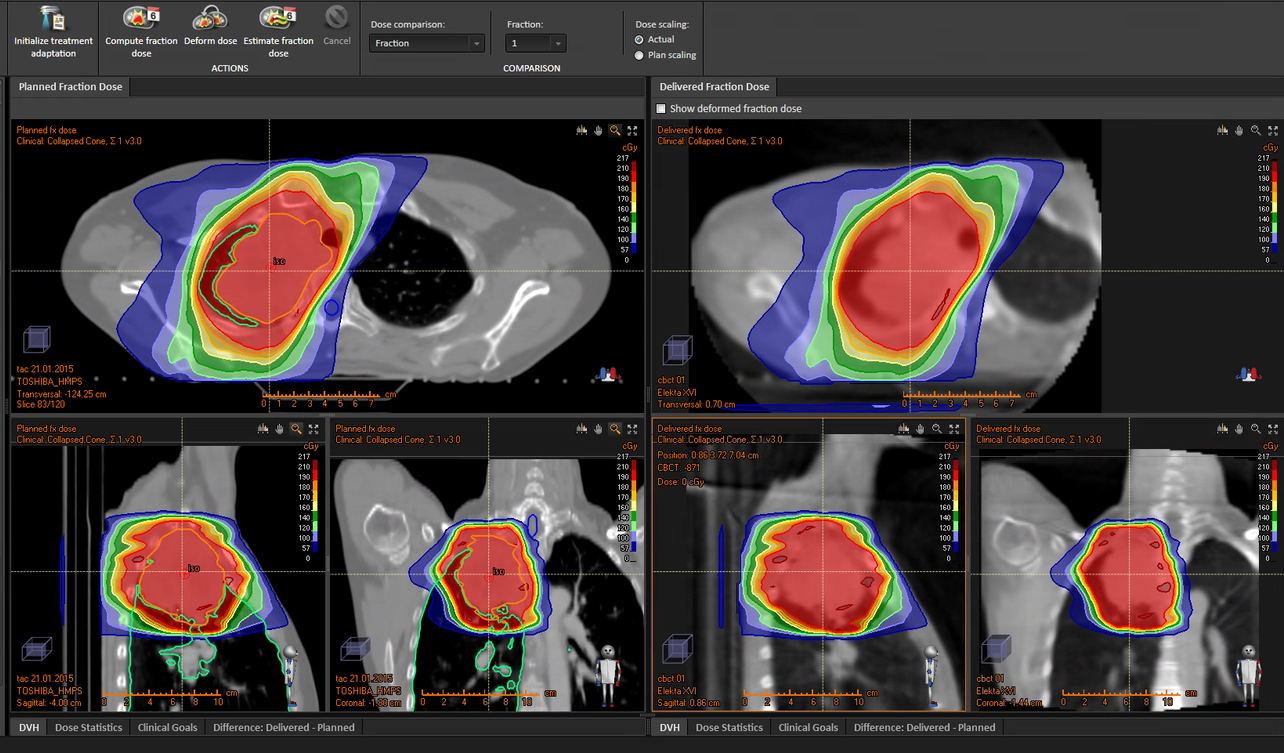 Planificación de pulmón con VMAT en acelerador VERSA HD. Se compara el plan en CT de referencia frente a la dosis que recibe el paciente sobre la imagen de kV-CBCT previa al tratamiento.