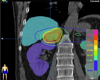 SBRT suprrarenal 3.png.jpg