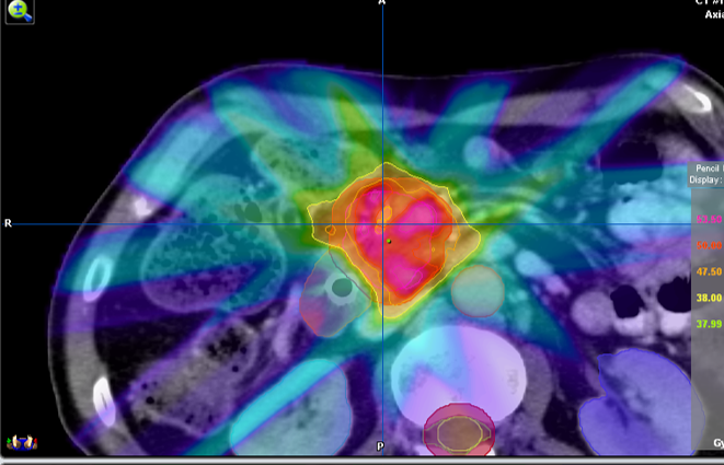 SBRT pancreas.png