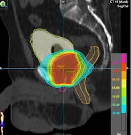 Prostata sbrt 1.jpg