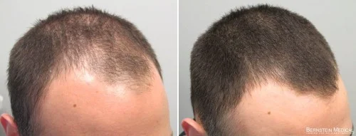 Yes, that minoxidil. ( Source )